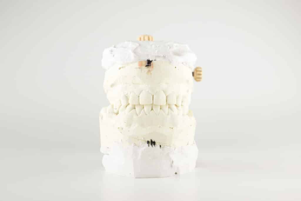 Bone Grafting Columbia