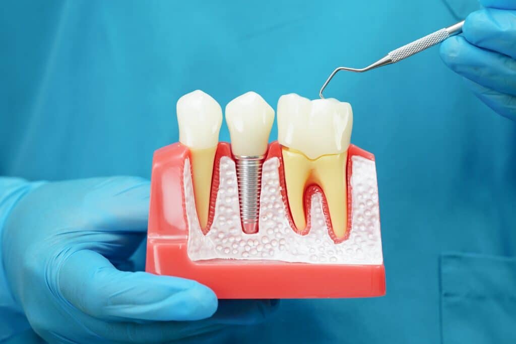 Dental Implants Columbia