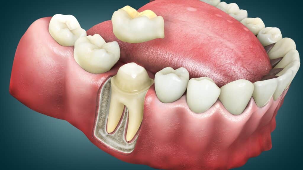 Dental Crowns Columbia