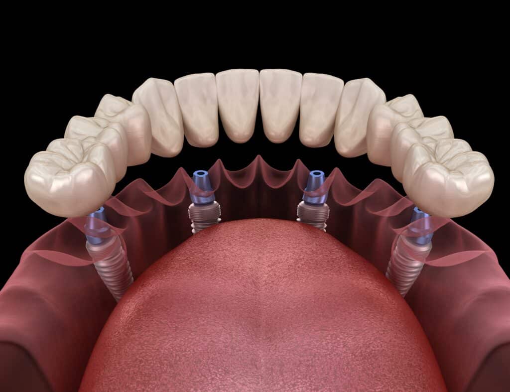 All-on-4 Dental Implants Columbia