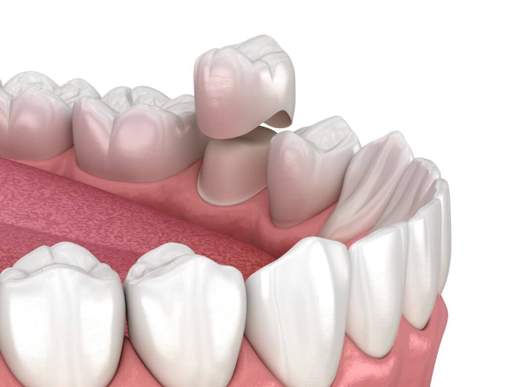 dental crown near me